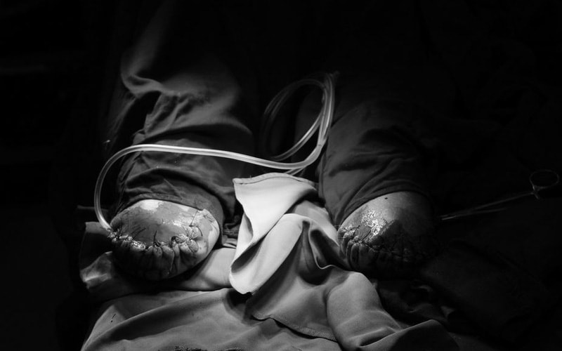 Sáng 3/3: Ca COVID-19 nặng tăng; Người đàn ông phải cắt cụt 2 bàn chân do biến chứng đái tháo đường - Ảnh 3. Sáng 3/3: Ca COVID-19 nặng tăng; Người đàn ông phải cắt cụt 2 bàn chân do biến chứng đái tháo đường - Ảnh 3.