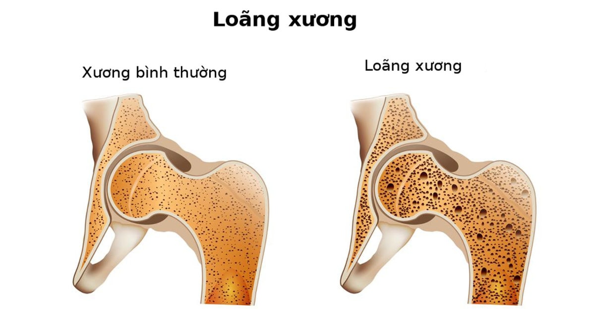 Không chỉ cần thiết cho bộ xương khỏe mạnh, canxi còn có nhiều tác dụng đặc biệt khác đối với cơ thể con người - Ảnh 3.