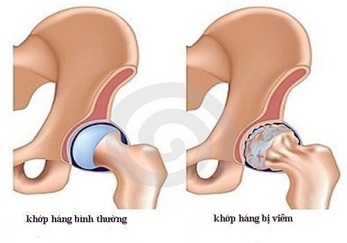 Viêm khớp háng ở trẻ cần phát hiện sớm - Ảnh 2.