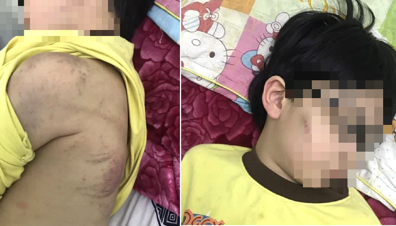 Nghi vấn, cháu bé 8 tuổi bị mẹ bạo hành do chưa làm bài tập - Ảnh 1. Nghi vấn, cháu bé 8 tuổi bị mẹ bạo hành do chưa làm bài tập - Ảnh 1.