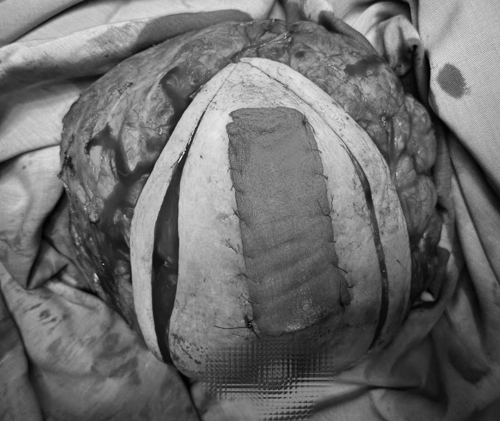 Chủ quan, ngại không đi khám, người phụ nữ đến bệnh viện với khối u vú 'khủng' hơn 3kg- Ảnh 2.