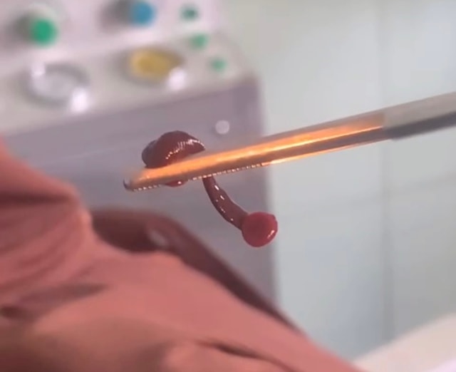 Phát hiện con vắt sống trong mũi người đàn ông suốt nhiều ngày- Ảnh 1.