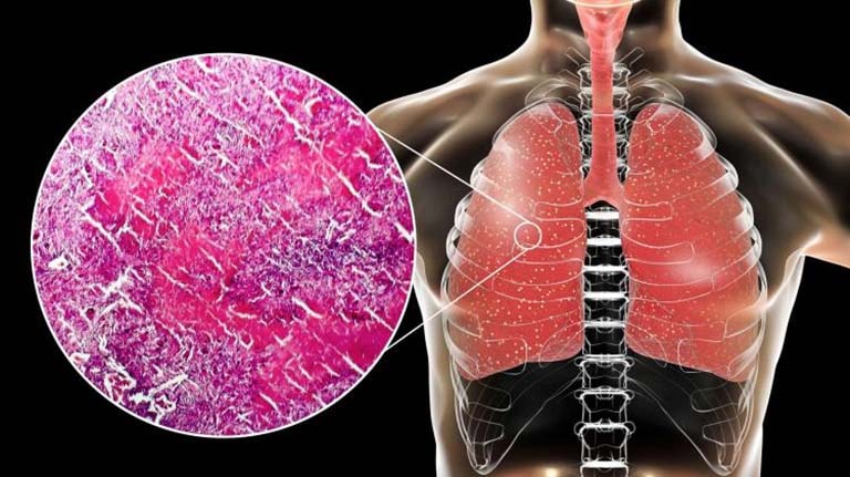 Chế độ dinh dưỡng cho người bệnh lao kê- Ảnh 1.