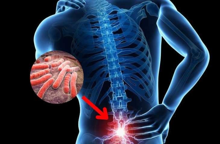 Dinh dưỡng hỗ trợ điều trị lao cột sống- Ảnh 1.