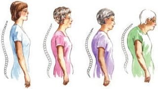 Chế độ ăn có ích với người gù cột sống- Ảnh 1.