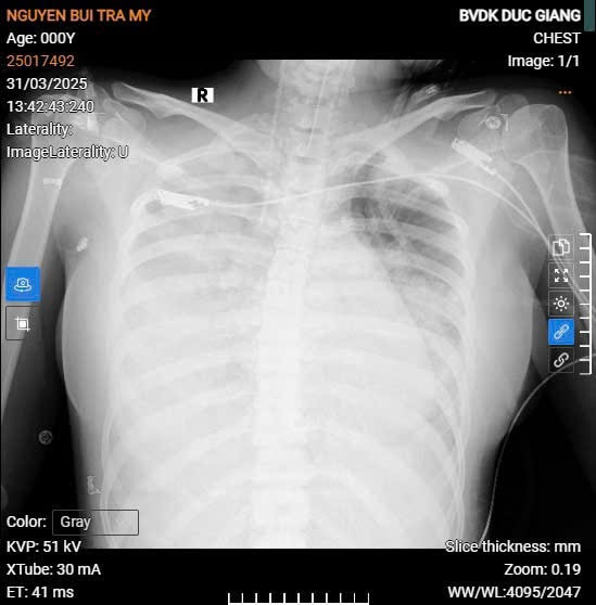 Chỉ với triệu chứng như cảm cúm, nữ sinh được phát hiện nhiễm liên cầu khuẩn nhóm A nguy kịch- Ảnh 1. Chỉ với triệu chứng như cảm cúm, nữ sinh được phát hiện nhiễm liên cầu khuẩn nhóm A nguy kịch- Ảnh 1.