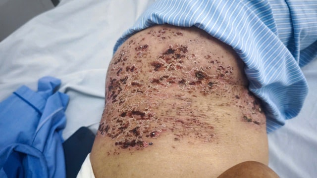 Nghĩ là 'giời leo' nên đắp đậu xanh, cụ ông bị tổn thương da nghiêm trọng do zona thần kinh- Ảnh 2. Nghĩ là 'giời leo' nên đắp đậu xanh, cụ ông bị tổn thương da nghiêm trọng do zona thần kinh- Ảnh 2.