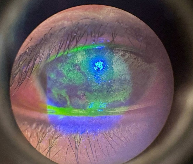 Suýt mù vì tự chữa mắt tại nhà, bác sĩ cảnh báo thói quen nhiều người dễ mắc- Ảnh 2. Suýt mù vì tự chữa mắt tại nhà, bác sĩ cảnh báo thói quen nhiều người dễ mắc- Ảnh 2.