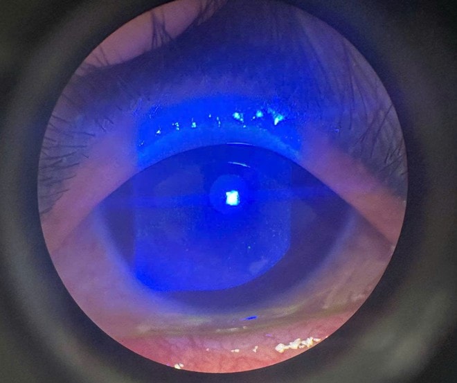 Suýt mù vì tự chữa mắt tại nhà, bác sĩ cảnh báo thói quen nhiều người dễ mắc- Ảnh 1. Suýt mù vì tự chữa mắt tại nhà, bác sĩ cảnh báo thói quen nhiều người dễ mắc- Ảnh 1.