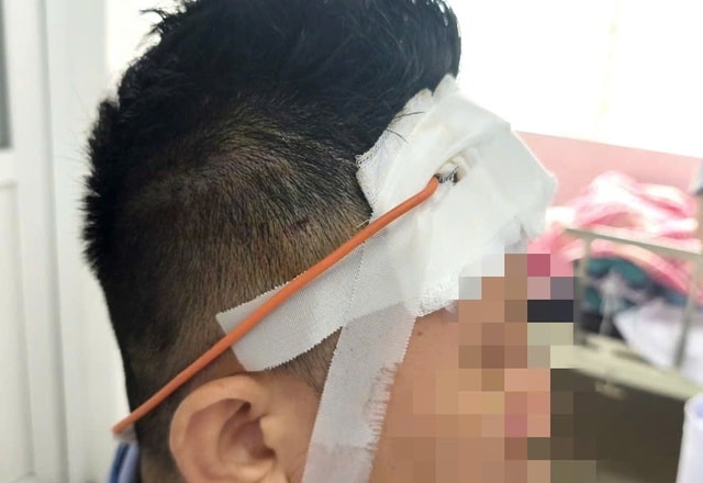 Bị ngã xe máy, một tháng sau người đàn ông được phát hiện máu tụ trong não- Ảnh 3.