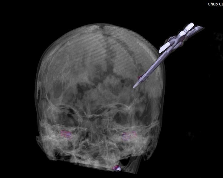 Cô gái 25 tuổi bị kéo nhọn đâm xuyên não- Ảnh 2. Cô gái 25 tuổi bị kéo nhọn đâm xuyên não- Ảnh 2.