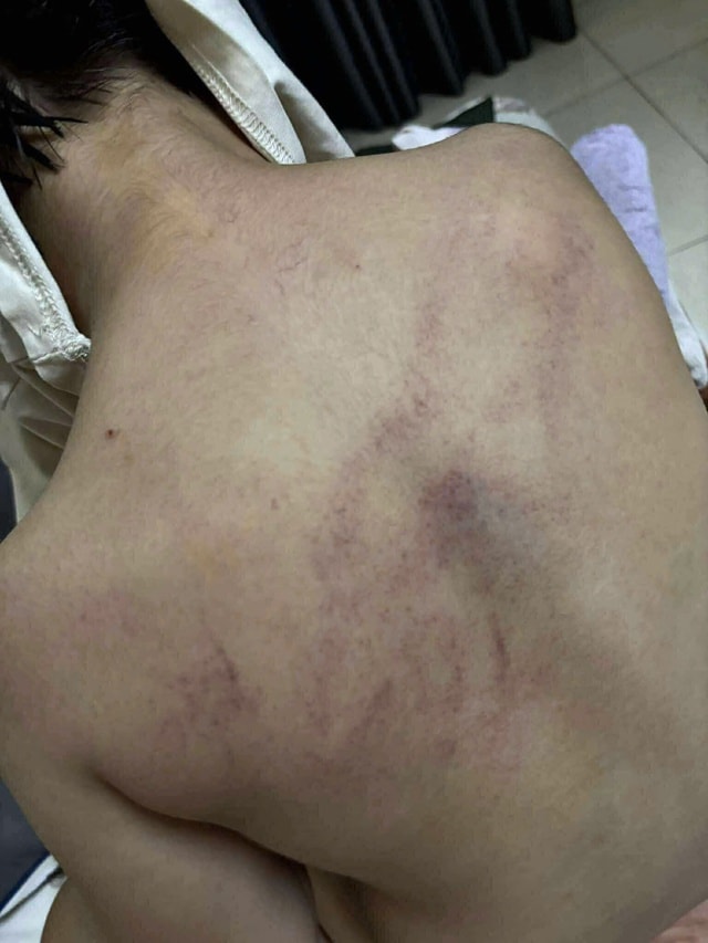 Bé gái mầm non nghi bị bạo hành, đánh tím lưng tại Hà Nội- Ảnh 2.