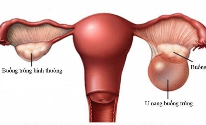 U nang buồng trứng khi nào cần phẫu thuật?- Ảnh 1.