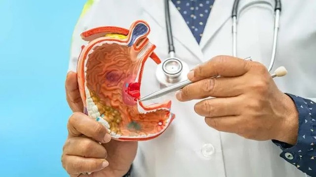 Nên và không nên ăn gì khi bị loét dạ dày?- Ảnh 1.