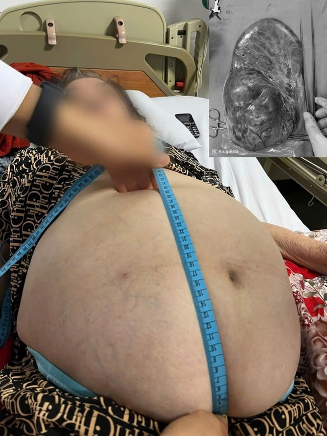 Cụ bà 75 tuổi có khối u chiếm gần toàn bộ ổ bụng - Ảnh 1.