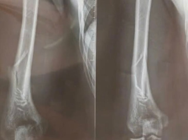 Chơi vật tay, nam thanh niên 18 tuổi bị gãy xương cánh tay- Ảnh 2.