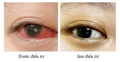 Cô gái bị loét giác mạc vì đeo kính áp tròng thay kính thường ròng rã- Ảnh 2.