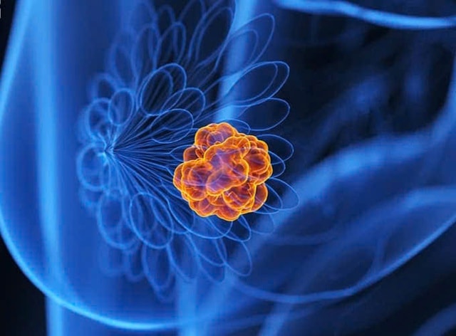 Trí tuệ nhân tạo (AI) giúp phát hiện chính xác ung thư vú- Ảnh 1.