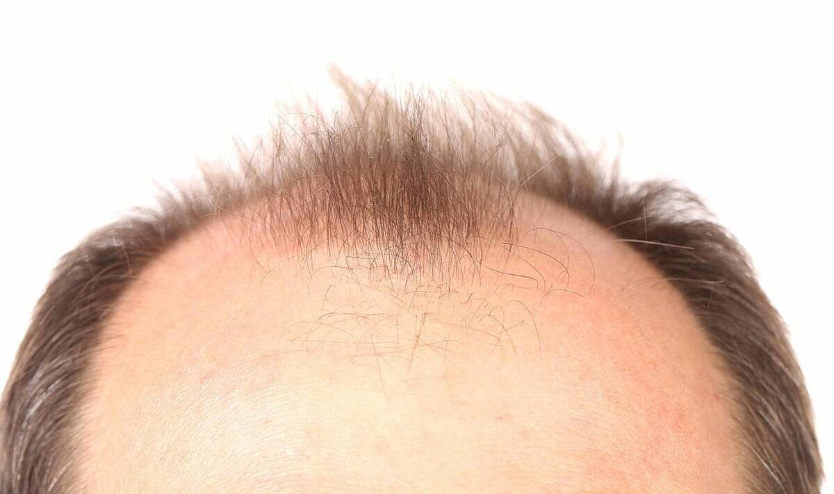 Đồ uống có đường - 'thủ phạm' gây rụng tóc ở nam giới- Ảnh 1.