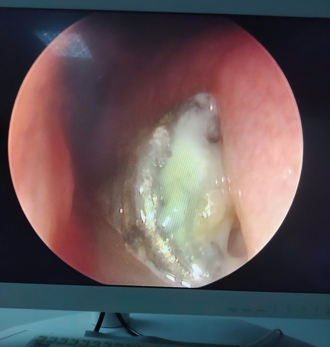 Dị vật pin 'cúc áo', hiểm hoạ khôn lường cho trẻ nhỏ- Ảnh 2. Dị vật pin 'cúc áo', hiểm hoạ khôn lường cho trẻ nhỏ- Ảnh 2.