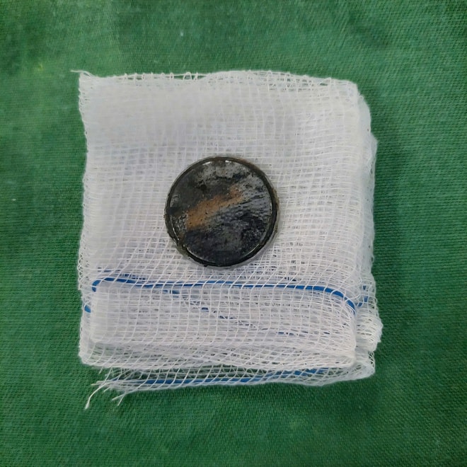 Dị vật pin 'cúc áo', hiểm hoạ khôn lường cho trẻ nhỏ- Ảnh 1. Dị vật pin 'cúc áo', hiểm hoạ khôn lường cho trẻ nhỏ- Ảnh 1.