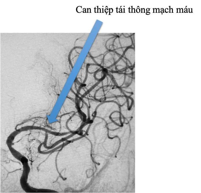 Đột quỵ do xơ vữa động mạch, làm gì để phòng tránh?- Ảnh 2.