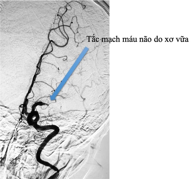 Đột quỵ do xơ vữa động mạch, làm gì để phòng tránh?- Ảnh 1.