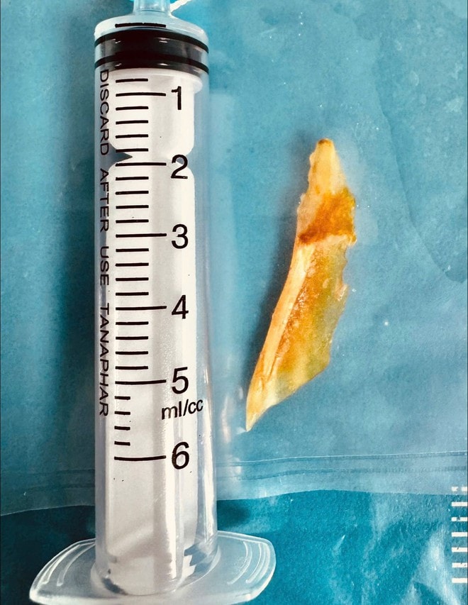 Cụ ông 80 tuổi thủng ruột do xương cá - Ảnh 2.