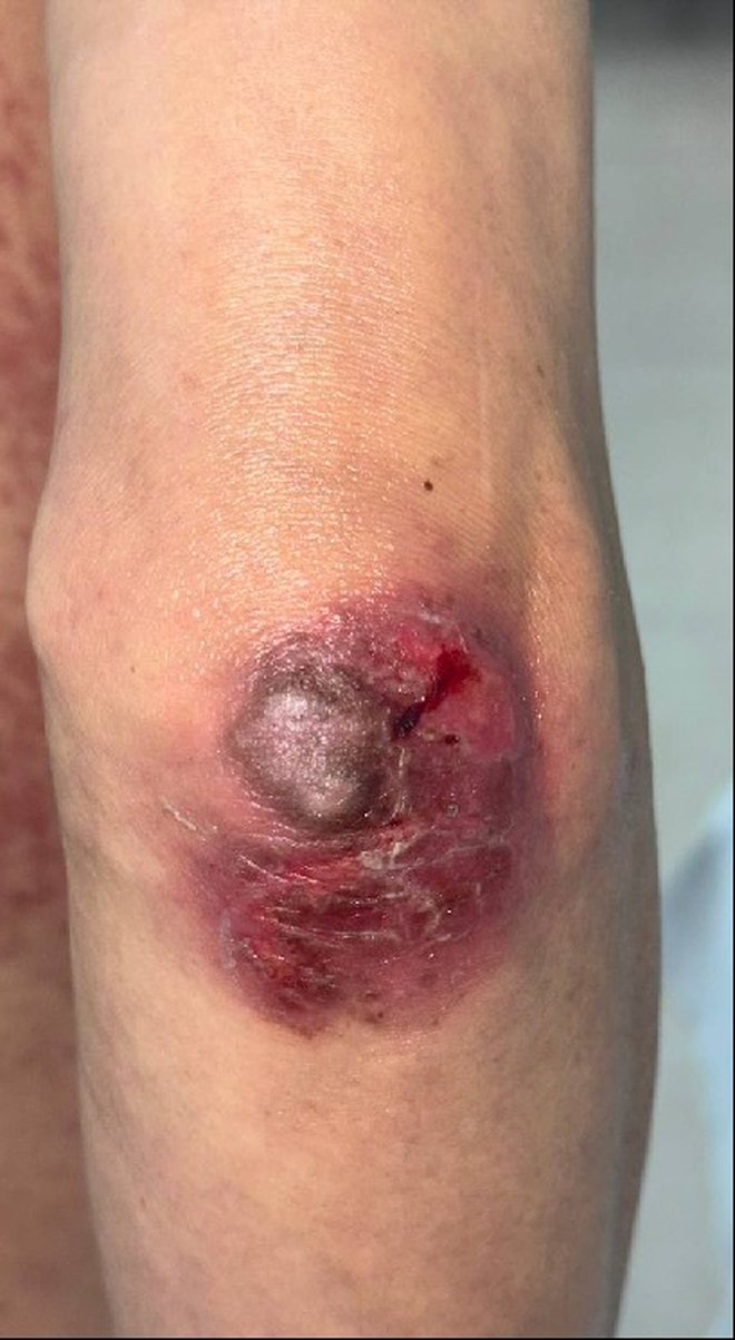 Uống sai liều thuốc da liễu, nhiều người ngộ độc nặng- Ảnh 4.