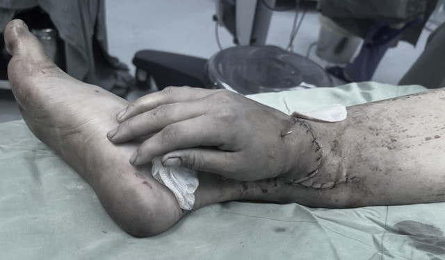 Người mẹ trẻ ở Bình Dương 'cầu xin' giữ lại bàn tay để được chăm con- Ảnh 1.