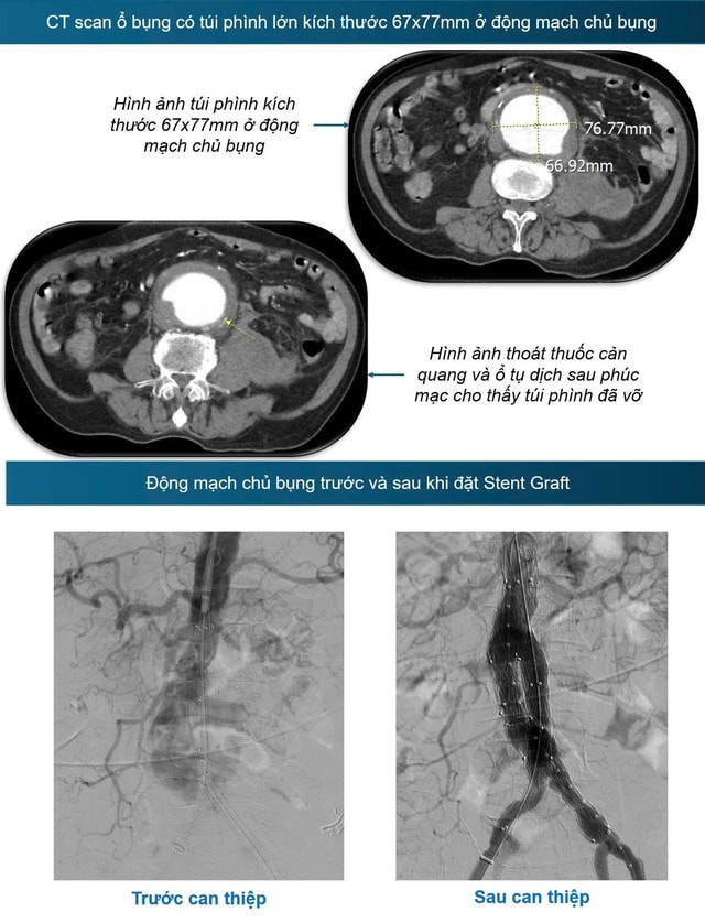 Cứu sống bệnh nhân vỡ động mạch chủ bụng bằng Stent graft- Ảnh 1. Cứu sống bệnh nhân vỡ động mạch chủ bụng bằng Stent graft- Ảnh 1.