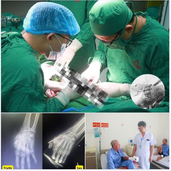 Bác sĩ cứu sống bàn tay bị vỡ nát cho bệnh nhân sau tai nạn giao thông- Ảnh 1. Bác sĩ cứu sống bàn tay bị vỡ nát cho bệnh nhân sau tai nạn giao thông- Ảnh 1.