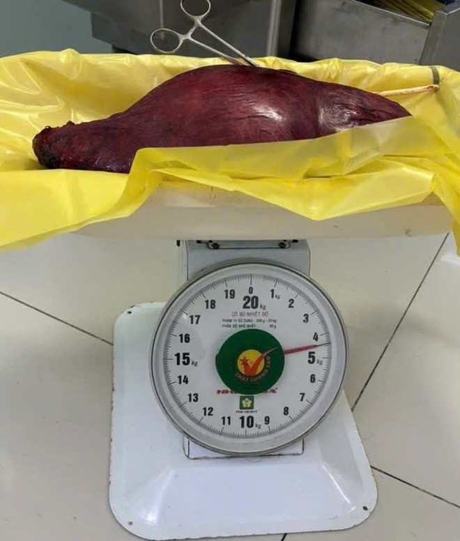 Cắt khối u xơ tử cung nặng 4,5kg, bụng nữ bệnh nhân to như thai 28 tuần- Ảnh 2. Cắt khối u xơ tử cung nặng 4,5kg, bụng nữ bệnh nhân to như thai 28 tuần- Ảnh 2.