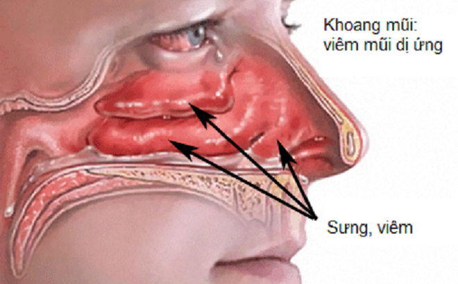 VIÊM MŨI DỊ ỨNG