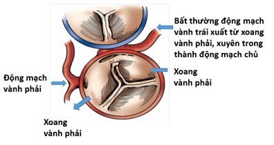 Mệt sau chạy bộ, bé gái 11 tuổi được phát hiện dị dạng mạch vành hiếm có, nguy cơ đột tử cao- Ảnh 2. Mệt sau chạy bộ, bé gái 11 tuổi được phát hiện dị dạng mạch vành hiếm có, nguy cơ đột tử cao- Ảnh 2.