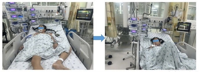 Mệt sau chạy bộ, bé gái 11 tuổi được phát hiện dị dạng mạch vành hiếm có, nguy cơ đột tử cao- Ảnh 1. Mệt sau chạy bộ, bé gái 11 tuổi được phát hiện dị dạng mạch vành hiếm có, nguy cơ đột tử cao- Ảnh 1.