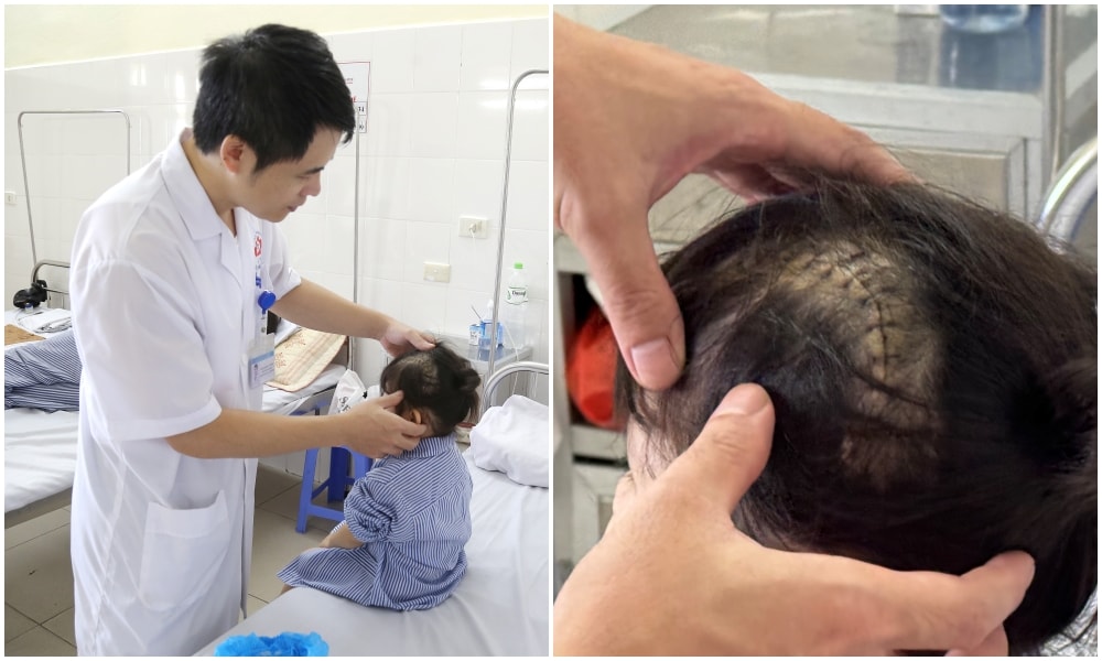Ngã cầu thang trong lúc chơi, bé 3 tuổi bị vỡ xương sọ, tụ máu ngoài màng cứng- Ảnh 2. Ngã cầu thang trong lúc chơi, bé 3 tuổi bị vỡ xương sọ, tụ máu ngoài màng cứng- Ảnh 2.