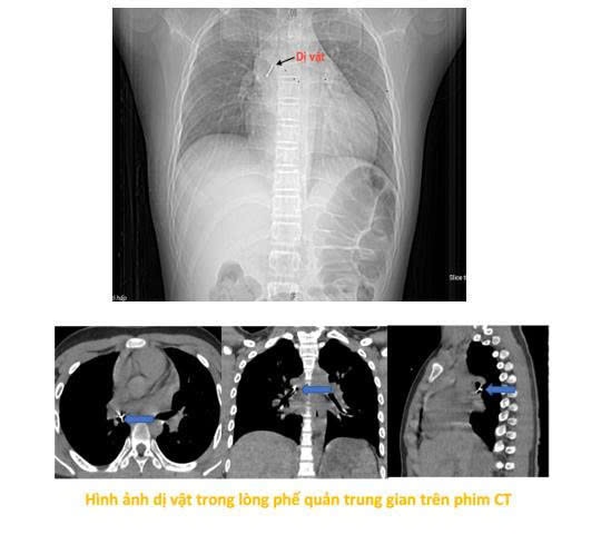 Vừa xem tivi vừa chơi, bé 13 tuổi nuốt đinh ghim vào đường thở- Ảnh 1.