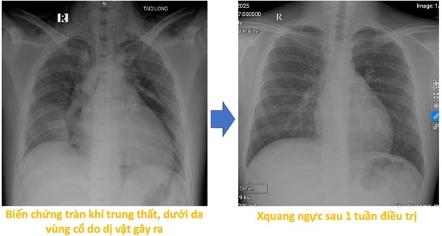 Vừa xem tivi vừa chơi, bé 13 tuổi nuốt đinh ghim vào đường thở- Ảnh 3.