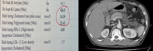 Cứu sống người đàn ông có chỉ số mỡ máu cao gấp 12 lần bình thường- Ảnh 2.
