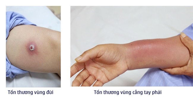 Cấy chỉ giảm đau xương khớp, người phụ nữ bị nhiễm trùng viêm mô bào- Ảnh 1. Cấy chỉ giảm đau xương khớp, người phụ nữ bị nhiễm trùng viêm mô bào- Ảnh 1.