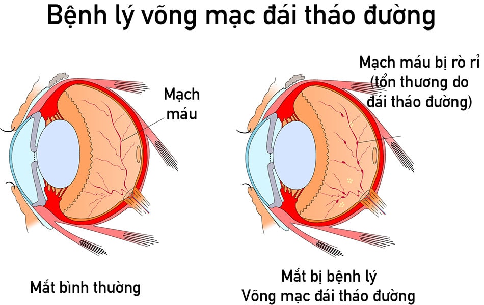 Có đến 1/3 bệnh nhân đái tháo đường bị mắc bệnh võng mạc- Ảnh 4. Có đến 1/3 bệnh nhân đái tháo đường bị mắc bệnh võng mạc- Ảnh 4.