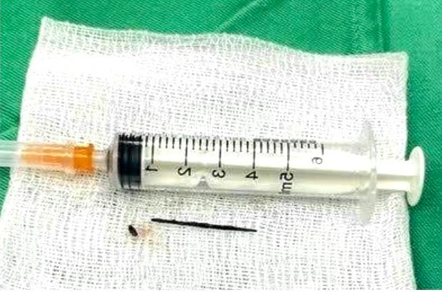 Người đàn ông 68 tuổi bị dị vật kim loại xuyên thủng dạ dày vào tụy- Ảnh 2. Người đàn ông 68 tuổi bị dị vật kim loại xuyên thủng dạ dày vào tụy- Ảnh 2.