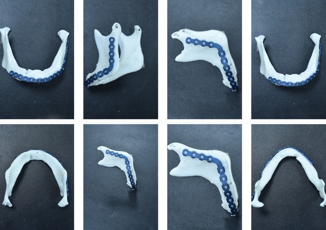 Ứng dụng công nghệ 3D trong tạo hình hàm mặt cho bệnh nhân mắc u não- Ảnh 3. Ứng dụng công nghệ 3D trong tạo hình hàm mặt cho bệnh nhân mắc u não- Ảnh 3.