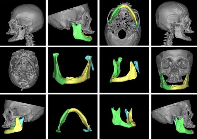 Ứng dụng công nghệ 3D trong tạo hình hàm mặt cho bệnh nhân mắc u não- Ảnh 4. Ứng dụng công nghệ 3D trong tạo hình hàm mặt cho bệnh nhân mắc u não- Ảnh 4.