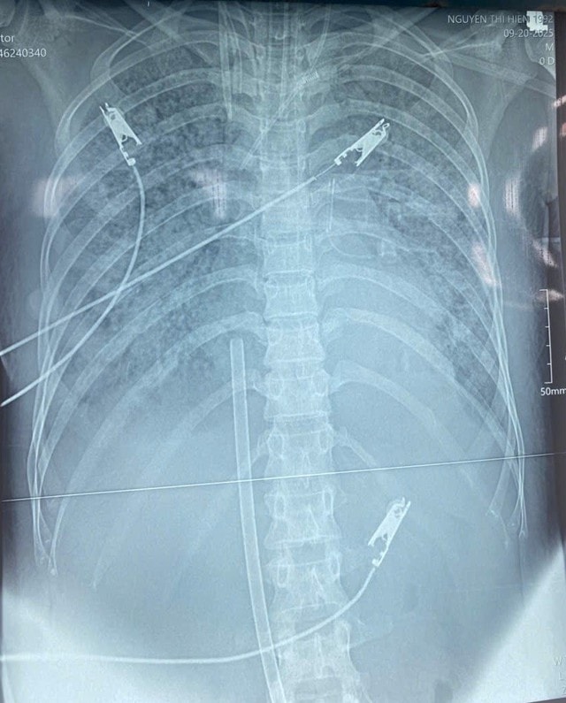 Bệnh viện Hữu nghị Đa khoa Nghệ An cứu sống bệnh nhân nguy kịch nhờ kỹ thuật Hybrid ECMO- Ảnh 2.