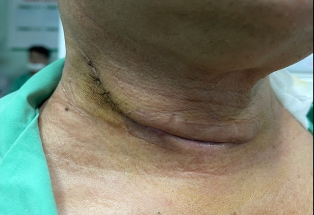 Phát hiện mắc cùng lúc 2 loại ung thư sau 6 tháng khàn tiếng- Ảnh 1. Phát hiện mắc cùng lúc 2 loại ung thư sau 6 tháng khàn tiếng- Ảnh 1.