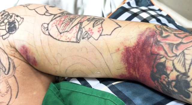 Thanh niên thợ mộc suýt mất tay chỉ vì bị muỗi đốt- Ảnh 2. Thanh niên thợ mộc suýt mất tay chỉ vì bị muỗi đốt- Ảnh 2.