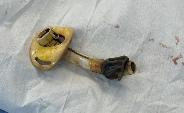 Người phụ nữ tìm lại hơi thở tự nhiên sau 7 năm sống cùng ống nội khí quản - Ảnh 1.