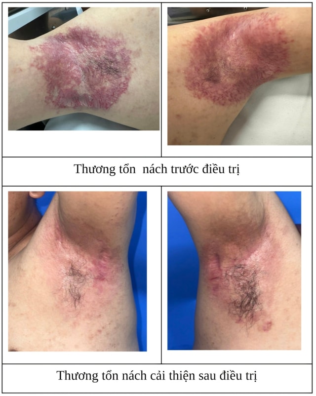 Thoát khỏi 6 năm đau đớn vì bệnh da hiếm gặp nhờ phương pháp điều trị mới- Ảnh 1.